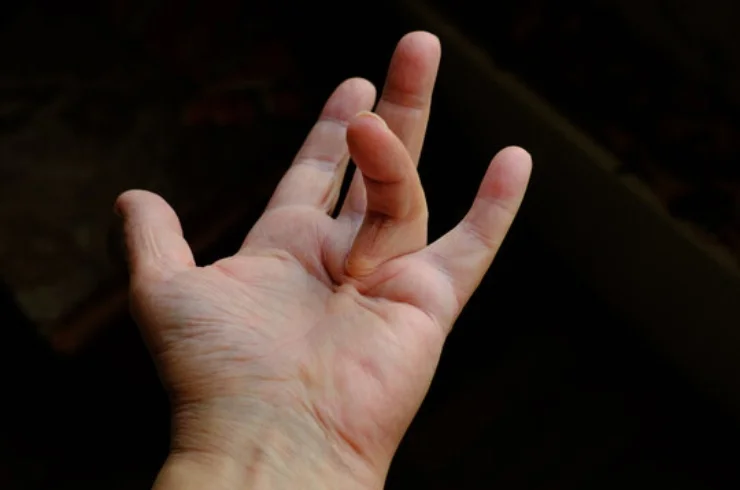 Dupuytren's Contracture....1